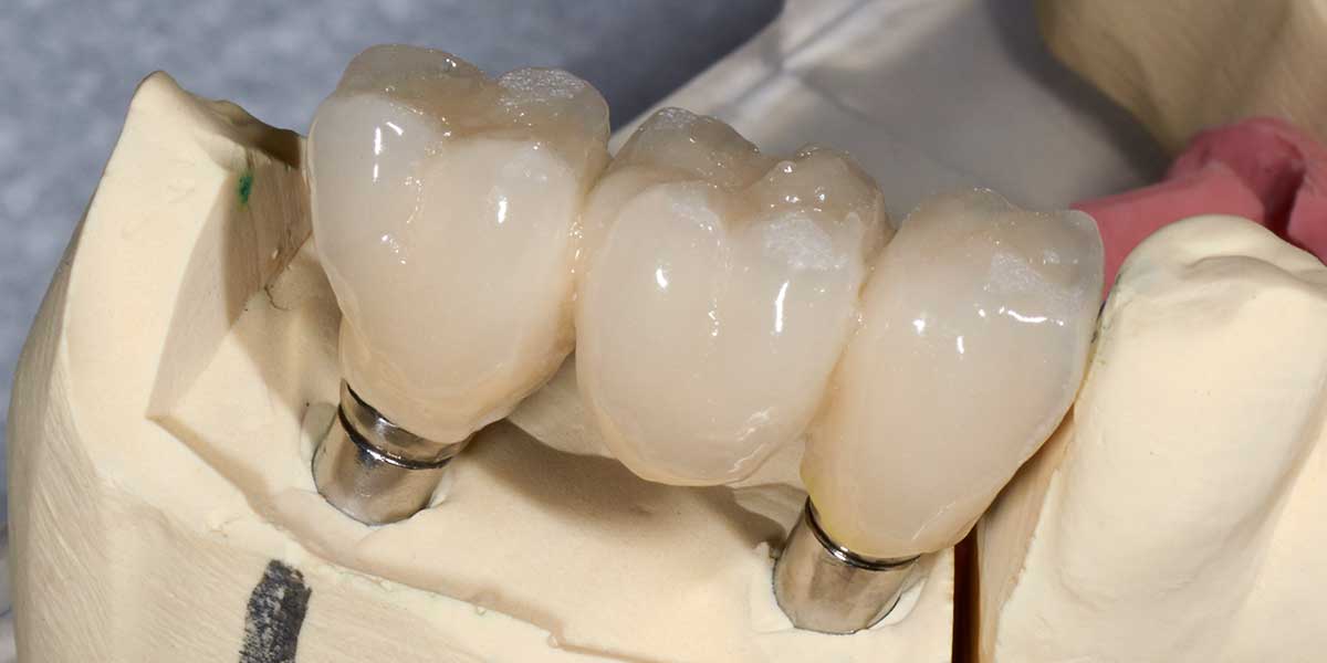 Dental Implant Supported Bridges in Montgomery