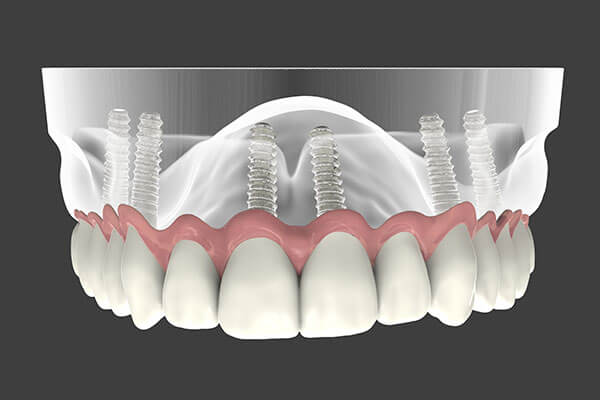 Implant Supported Dentures in Montgomery