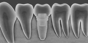 Dental Implants in Montgomery