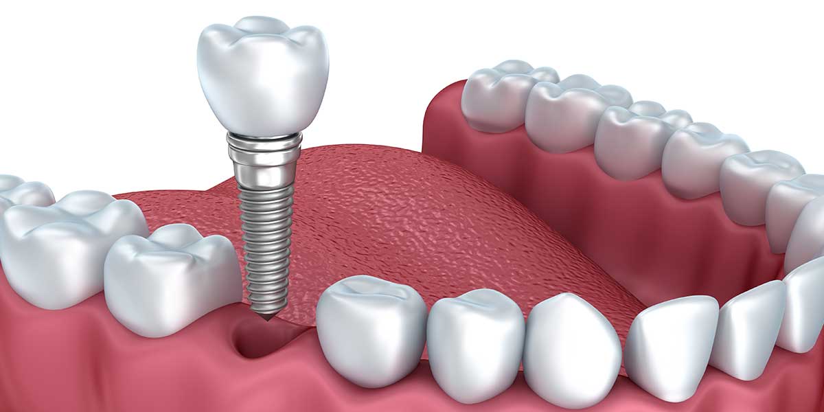 Single Dental Implants in Montgomery