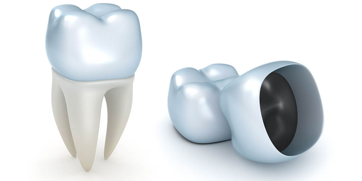 CAD/CAM Dentistry