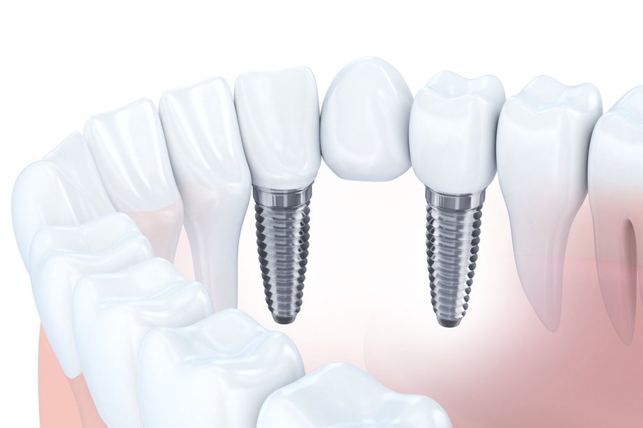 Dental bridge diagram