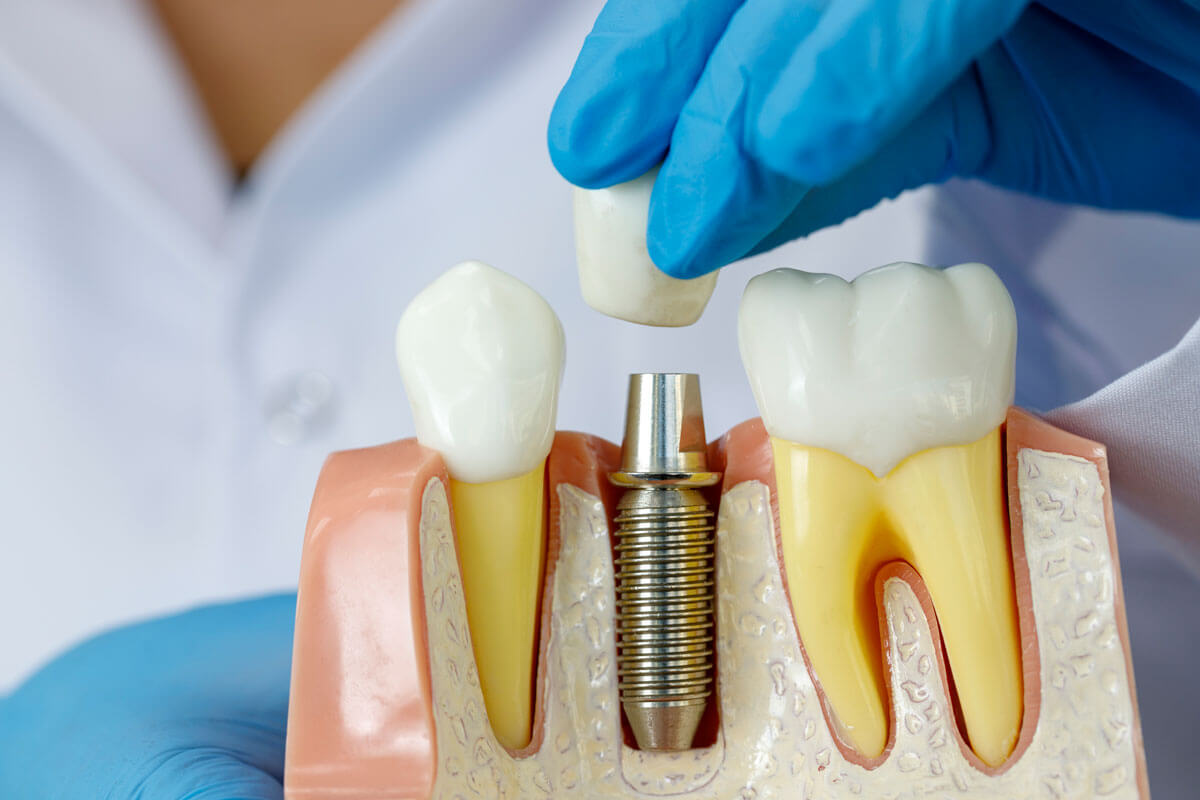 Bone Grafting for Dental Implants Montgomery, AL