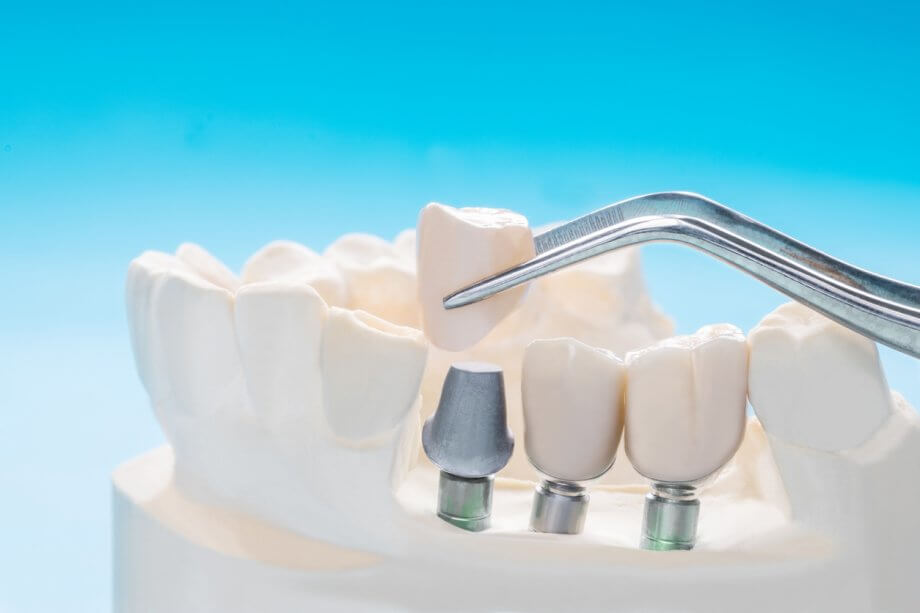 Model Of Dental Implants