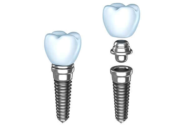 Single Tooth Dental Implants in Montgomery