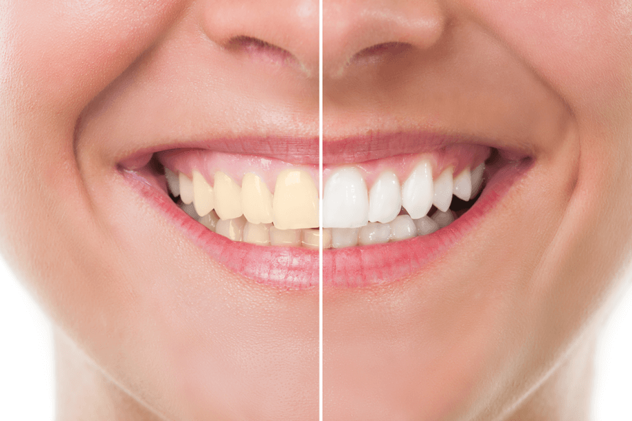 How Much Is Teeth Whitening in Montgomery, AL?
