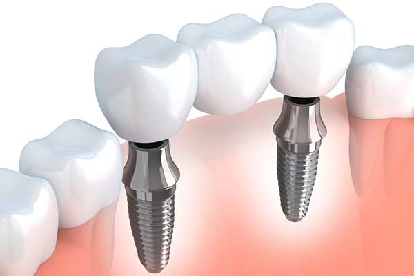 Implant Supported Bridges in Montgomery