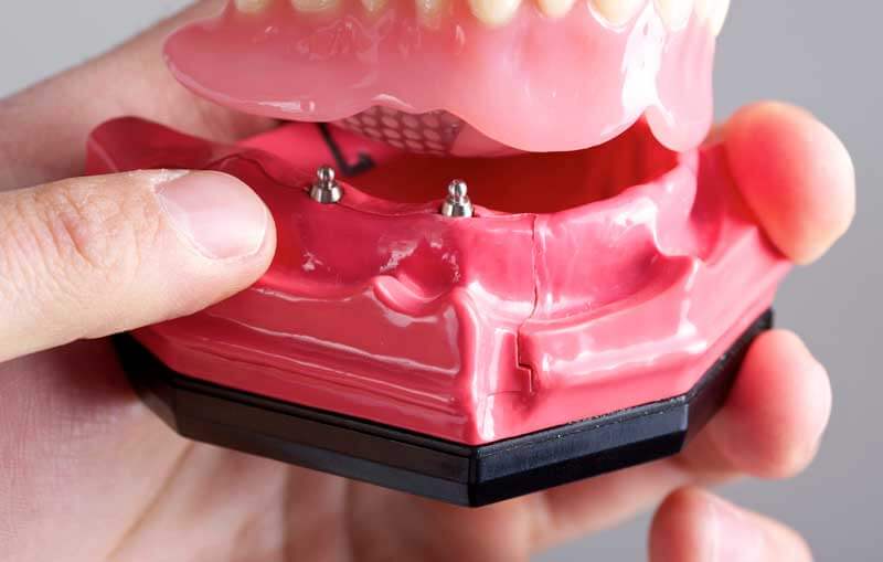 Mini Dental Implants in Montgomery